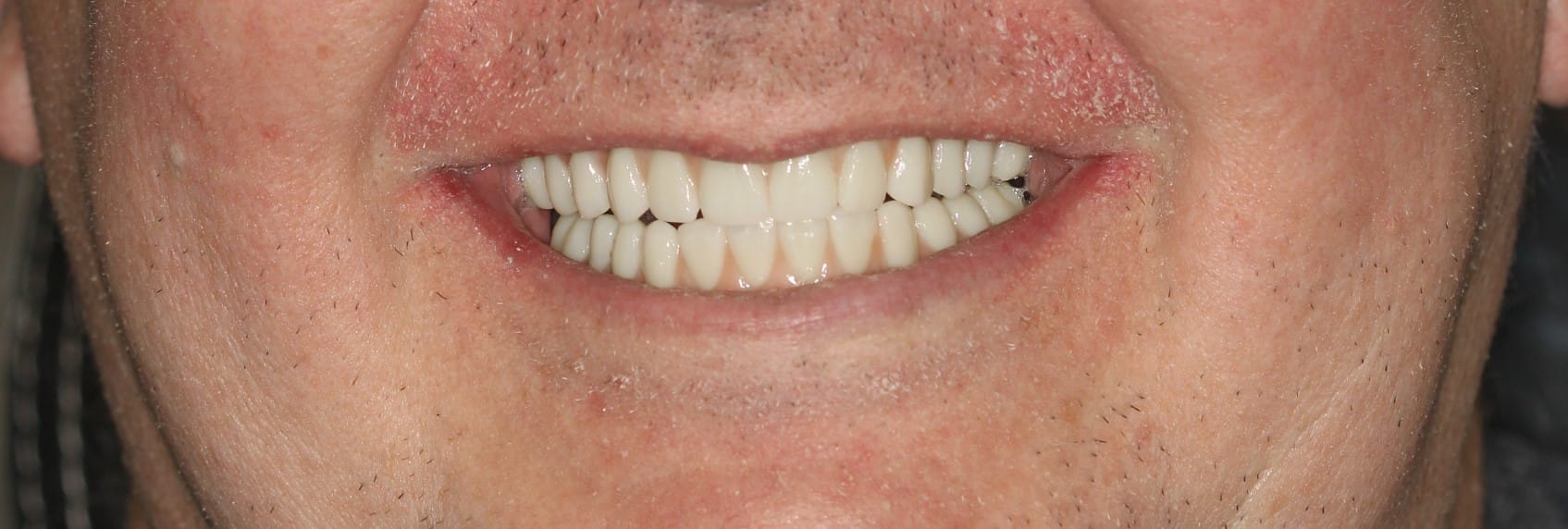 Close-up of a person's mouth after receiving implant dentures