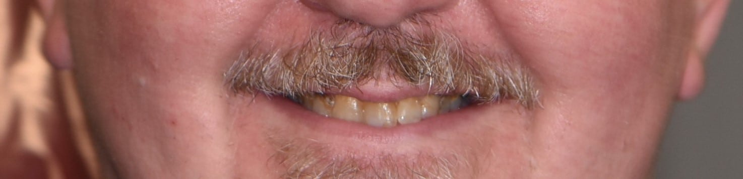 Close-up of a person's mouth before receiving implant dentures