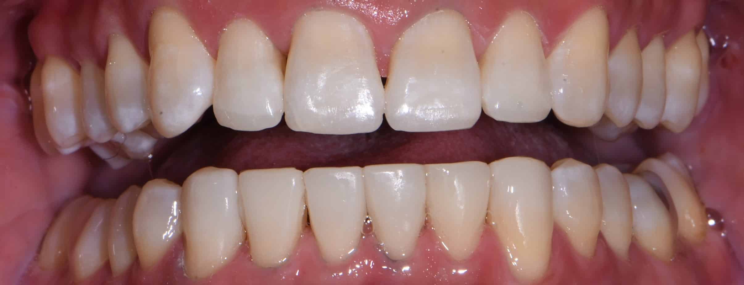 Close-up of a patient's teeth after Invisalign treatment and occlusion buildup