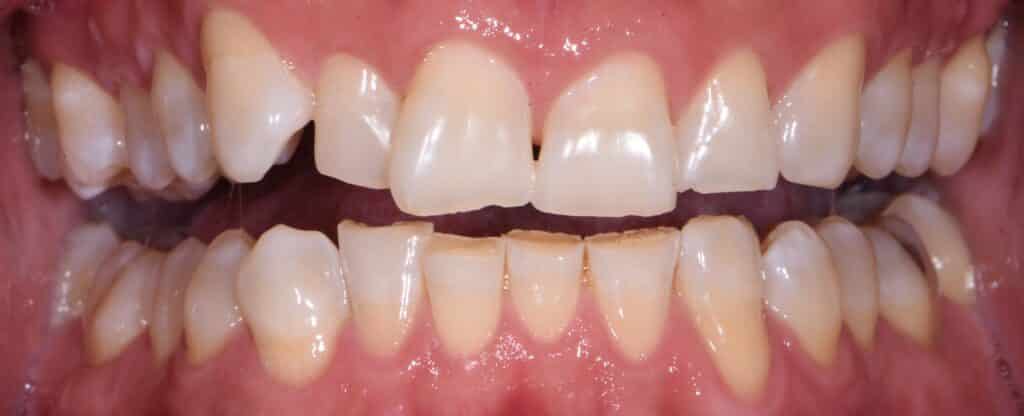 Close-up of a patient's misaligned teeth before Invisalign treatment and occlusion buildup