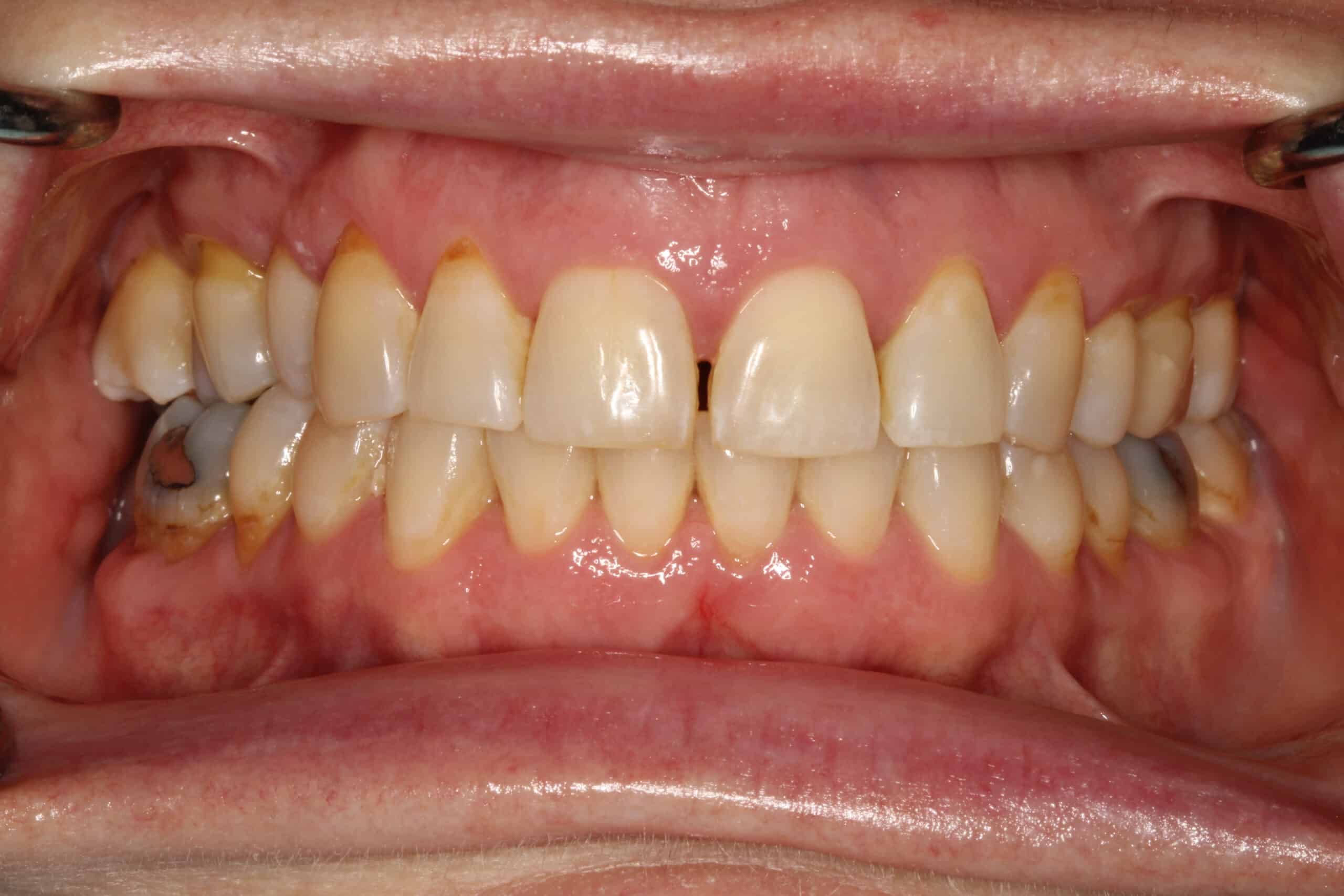 Close-up of a person's teeth before Zoom whitening treatment