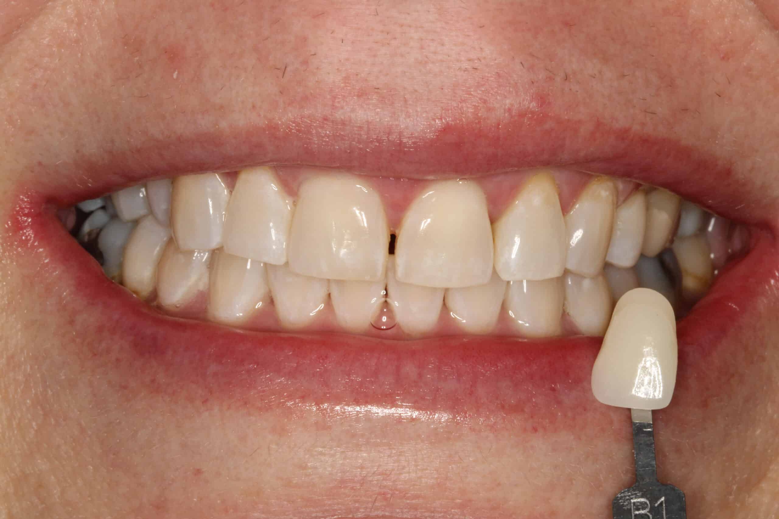 Close-up of a person's teeth after Zoom whitening treatment, showing bright, evenly whitened teeth with a smooth