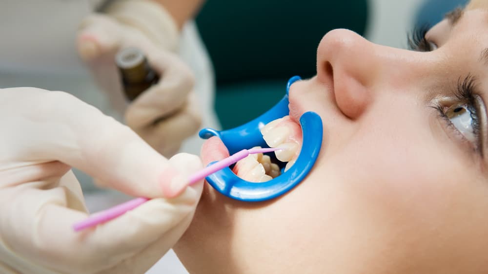 A woman receives a dental cleaning, while a dentist applies sealants to her teeth for added protection