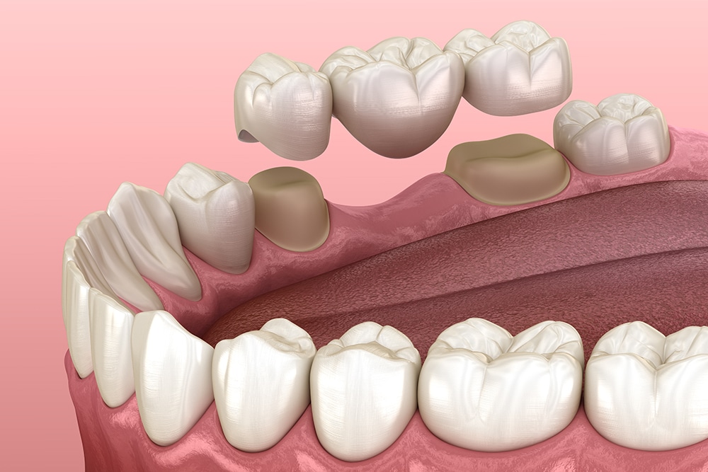 Close-up of dental bridges in place, showing the restoration of missing teeth and improved oral function