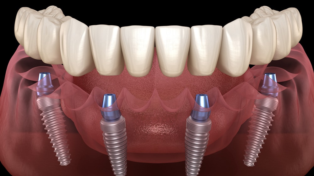 An illustration of a dental implant system using the All-on-4 method, featuring several implants in a clinical environment