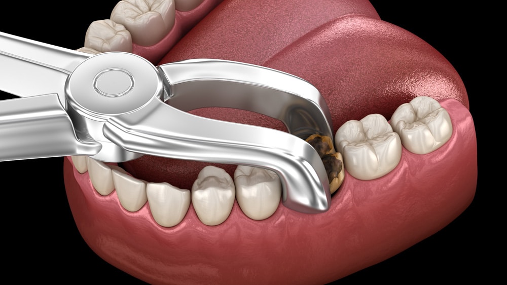 Close-up of dental professional employs an instrument to perform a tooth extraction, highlighting the procedure in a dental clinic