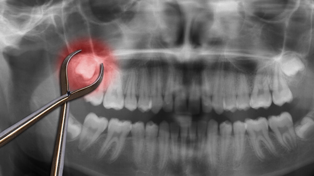 A dental tool positioned near a tooth on an X-ray, demonstrating the preparation for a wisdom teeth extraction procedure