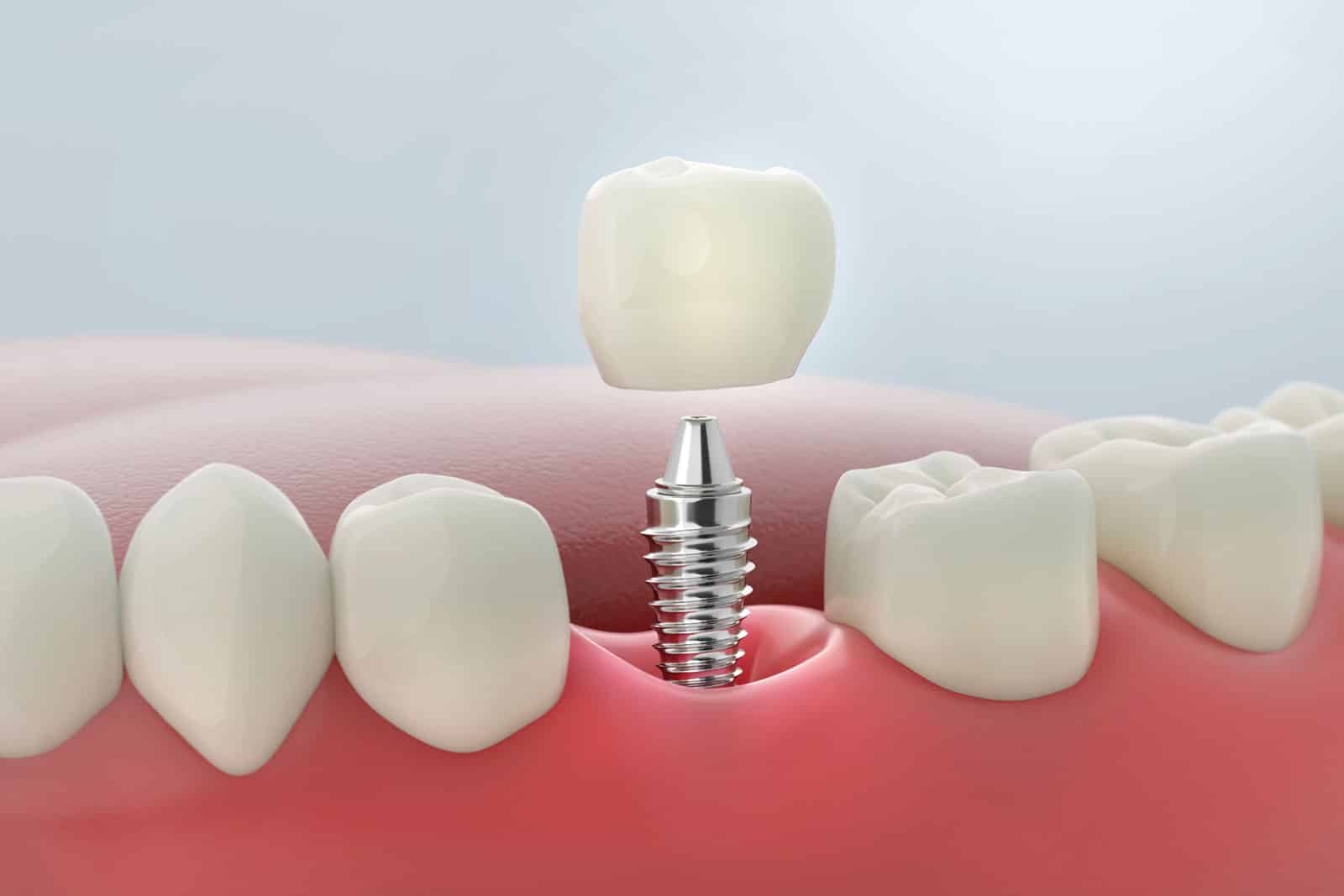 Close-up of dental implants demonstrating the secure and natural-looking solution for replacing missing teeth