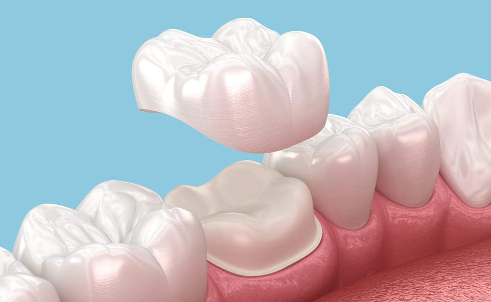 Close-up view of dental crowns, illustrating the restoration of damaged teeth for improved strength and appearance